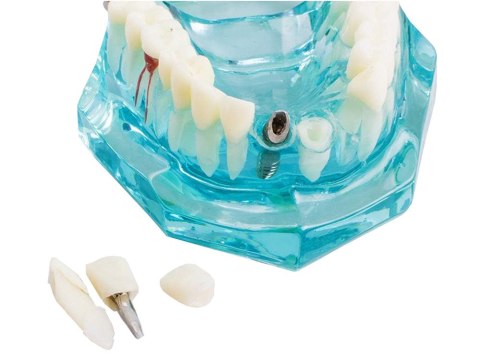 Model stomatologiczny szczęka zęby zębow implanty Model stomatologiczny szczęka zęby zębow implanty